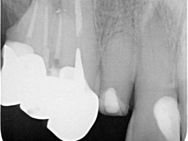 NAVIGOVANÁ ENDODONCIE ZUBU 12 S NEPRŮCHODNÝM KANÁLKEM